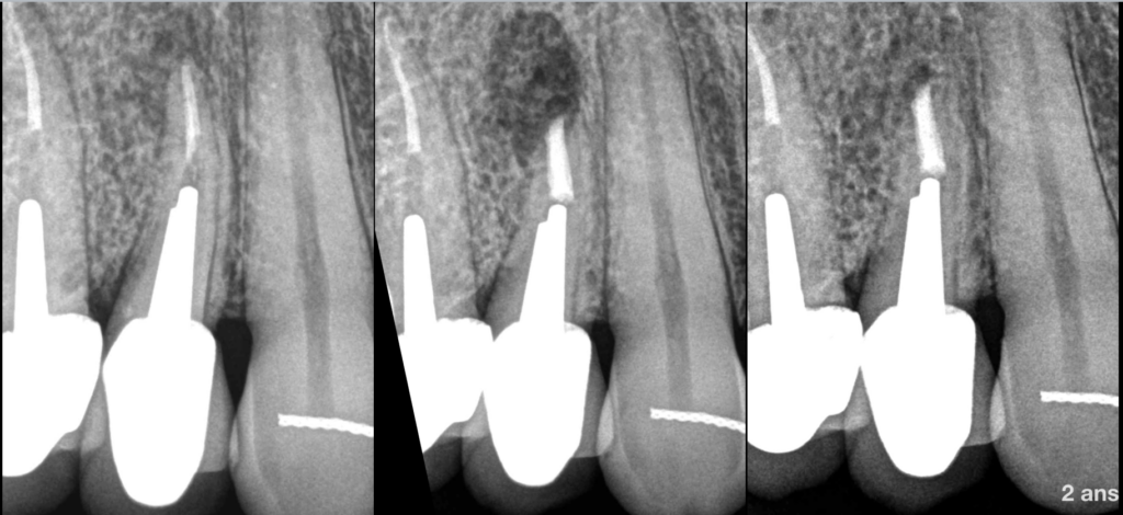 BLOG - Dr Brice Riera - Endodontiste Paris 17e - gradient therapeutique