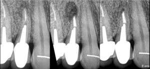 BLOG - Dr Brice Riera - Endodontiste Paris 17e - gradient therapeutique