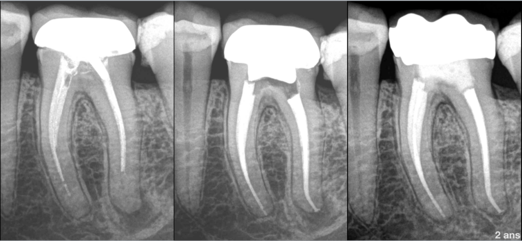 BLOG - Dr Brice Riera - Endodontiste - objectif dun traitement canalaire