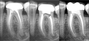 BLOG - Dr Brice Riera - Endodontiste - objectif dun traitement canalaire