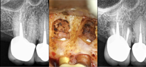 BLOG - Dr Brice Riera - Pronostic guerison osseuse - endodontie
