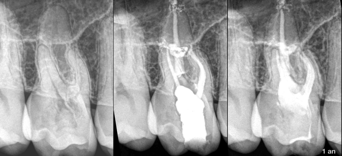 BLOG - Dr Brice Riera - Resorption radiculaire - Endodontie