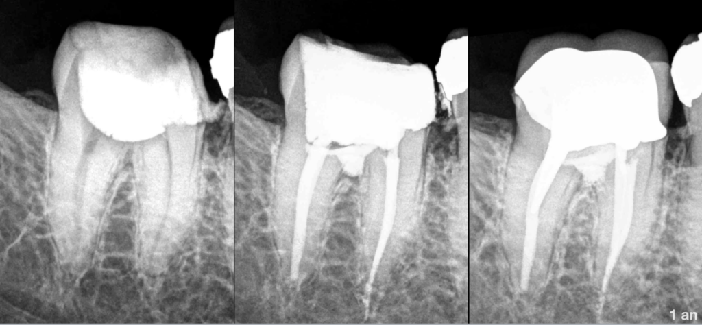 BLOG - Dr Brice Riera - Traitement de la perforation - Endodontie
