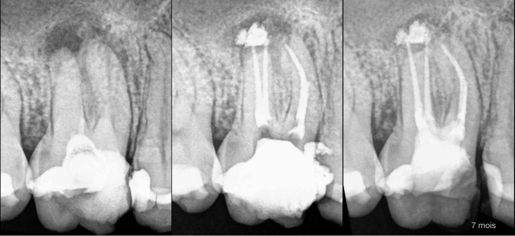 Blog - Dr Brice Riera- Endodontie - explication persistance douleur patient