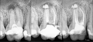 Blog - Dr Brice Riera- Endodontie - explication persistance douleur patient