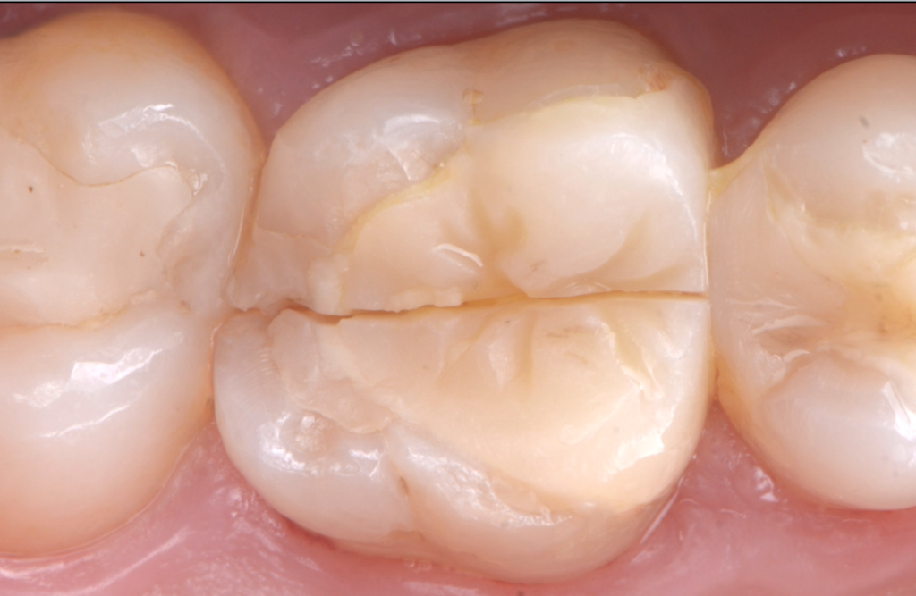 onlay casse - dr brice riera - endodontiste paris