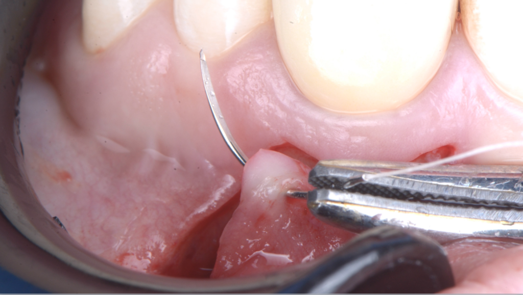 BLOG - Dr Brice RIera - Endodontie - Intervention au DU d'endodontie de l'université de Paris