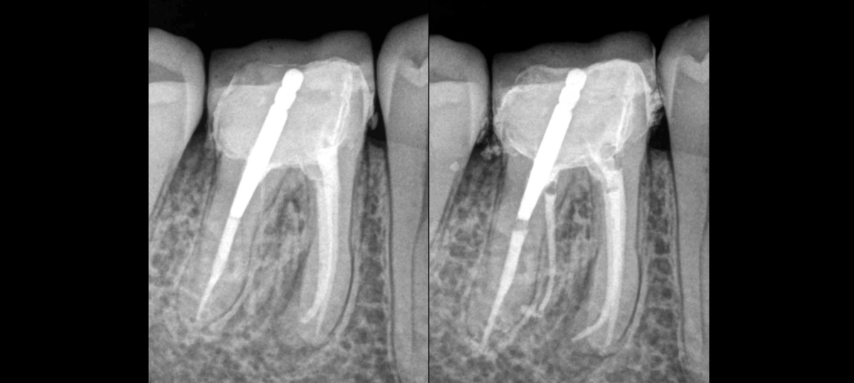 BLOG - Dr Brice Riera Chirurgien Dentiste Endodontiste - Paris 17e arrondissement - particularite dent