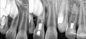 BLOG - Dr Brice Riera Endodontie 17e Paris - pulpe necrosee