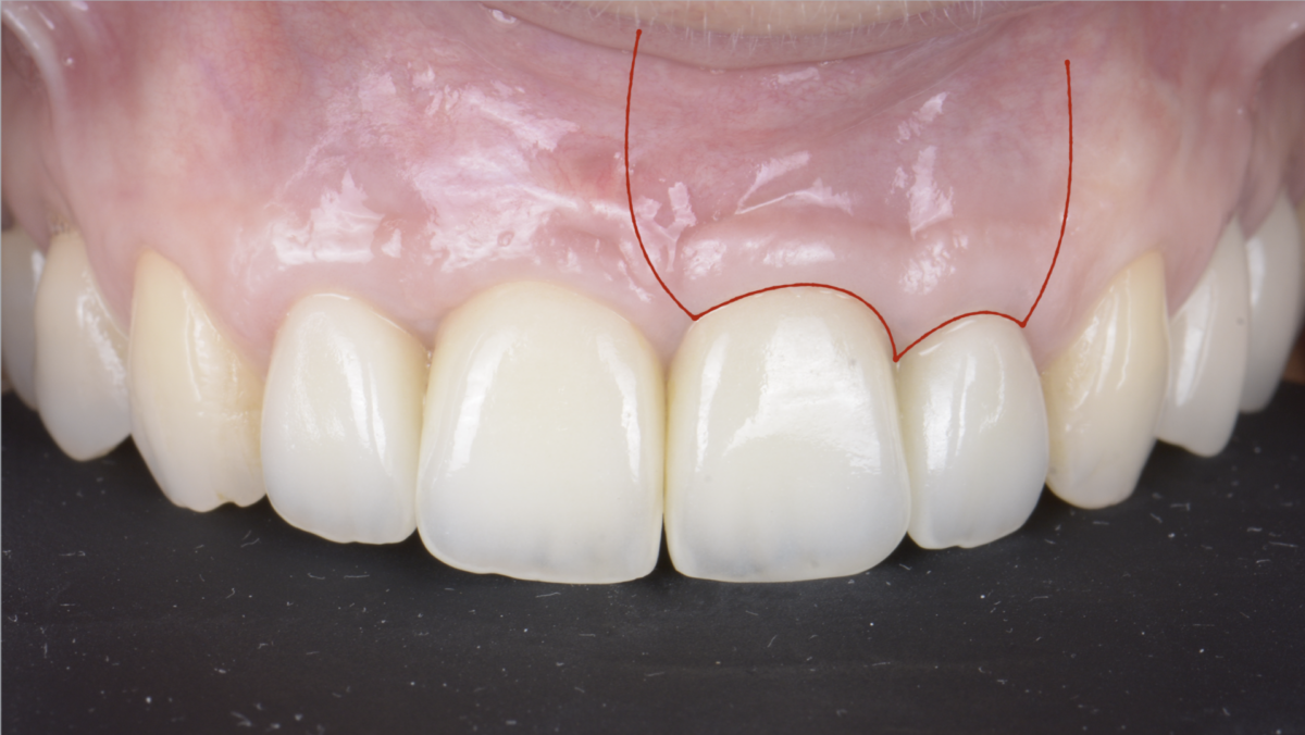 BLOG - Dr Brice Riera - Endodontie - Carrousel LI - Incision para marginale ou intra