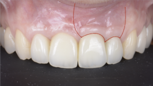 BLOG - Dr Brice Riera - Endodontie - Carrousel LI - Incision para marginale ou intra