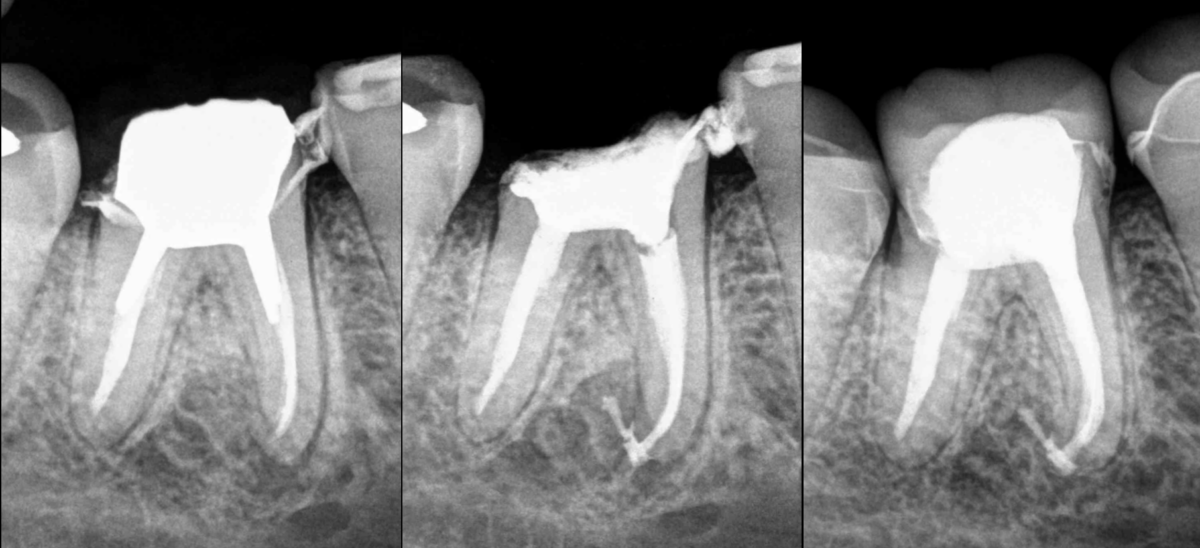 BLOG - Dr Brice Riera - Endodontie - Chirurgie dentaire - conseil prothetique apres traitement canalaire