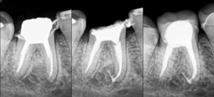 BLOG - Dr Brice Riera - Endodontie - Chirurgie dentaire - conseil prothetique apres traitement canalaire