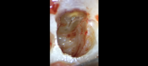 BLOG - Dr Brice Riera - Endodontie - Intervenant formation endo academie