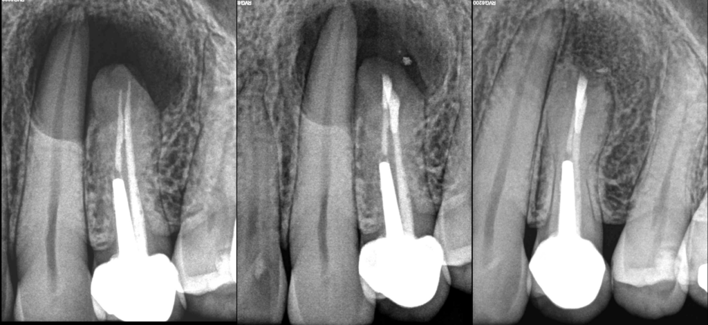 BLOG - Dr Brice Riera - Endodontie - NEcrose de la 23