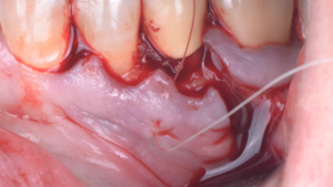 BLOG - Dr Brice Riera - Endodontie - choix fil de suture