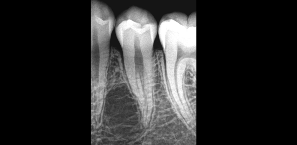 BLOG - Dr Brice Riera - Endodontie - traiter ou ne pas traiter