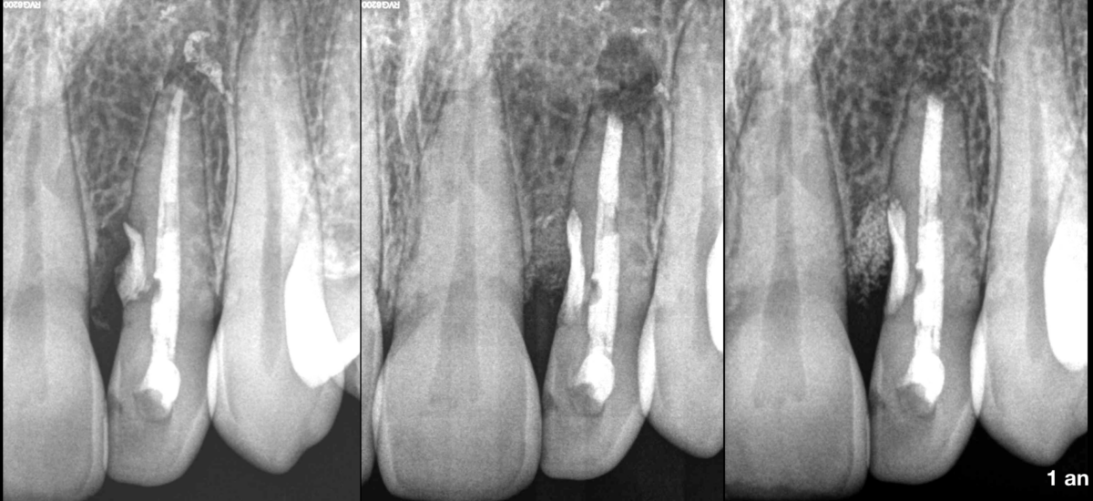 BLOG - Dr Brice Riera Endodontiste Paris 17e Chirurgien Dentiste - microchirurgie cas