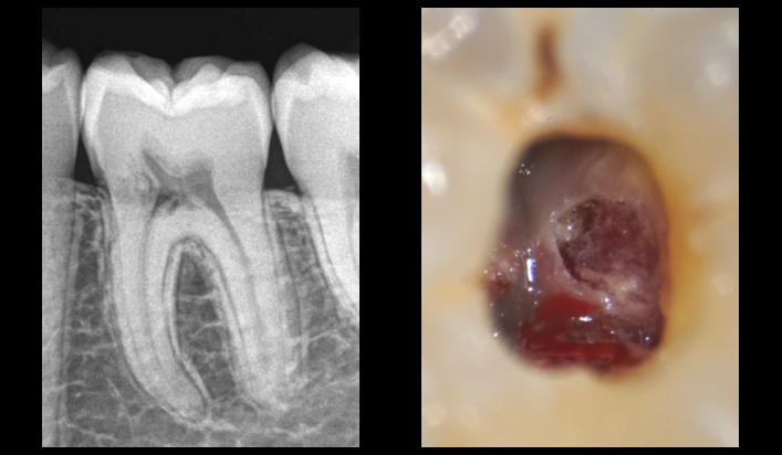 BLOG - Dr Brice Riera - ODF - Endodontie