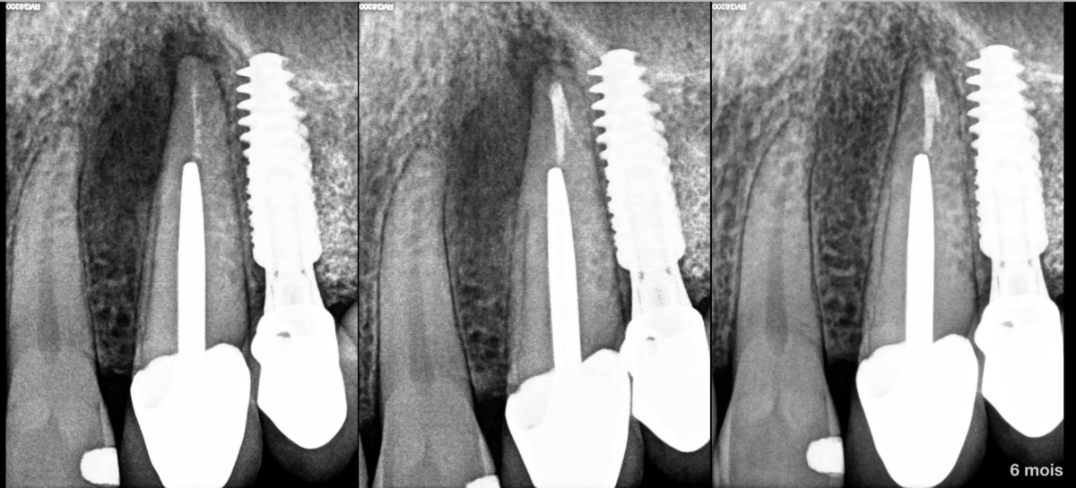 Risque de péri-implantite et lésion apicale sur implant à proximité
