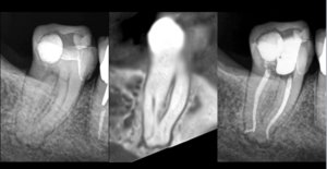 BLOG - Dr brice Riera - Endodontieu 17e arrondissement Paris - anatomie complexe et endodontie
