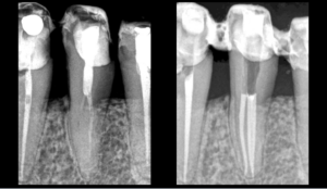 BLOG - Dr brice riera - techniques dobturation - endodontie