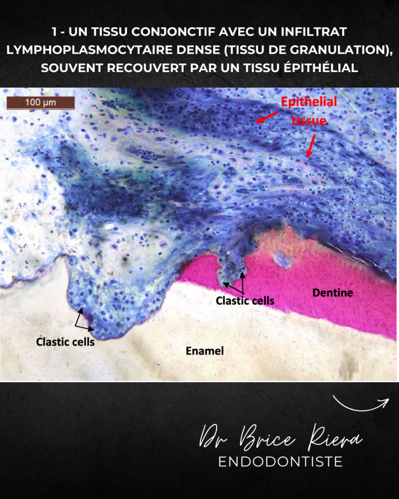 Résorption initiée dans le cément