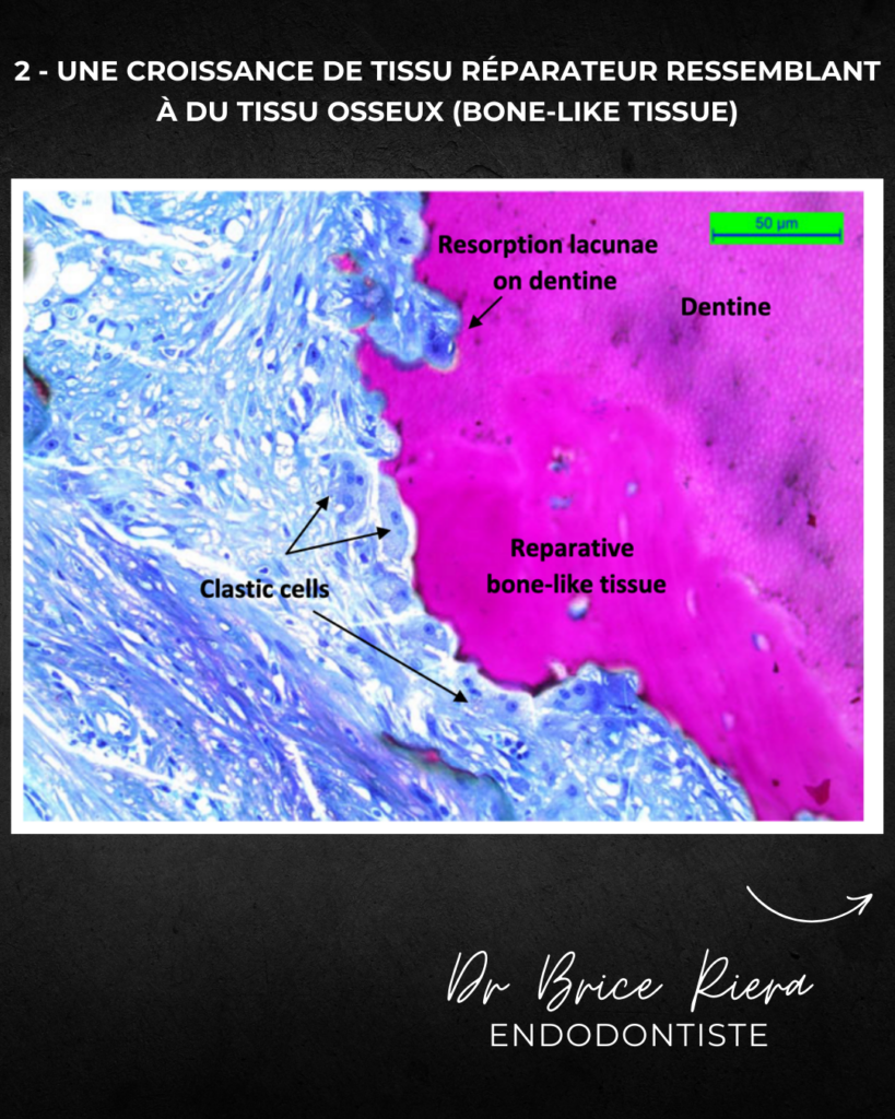 Résorption initiée dans le cément