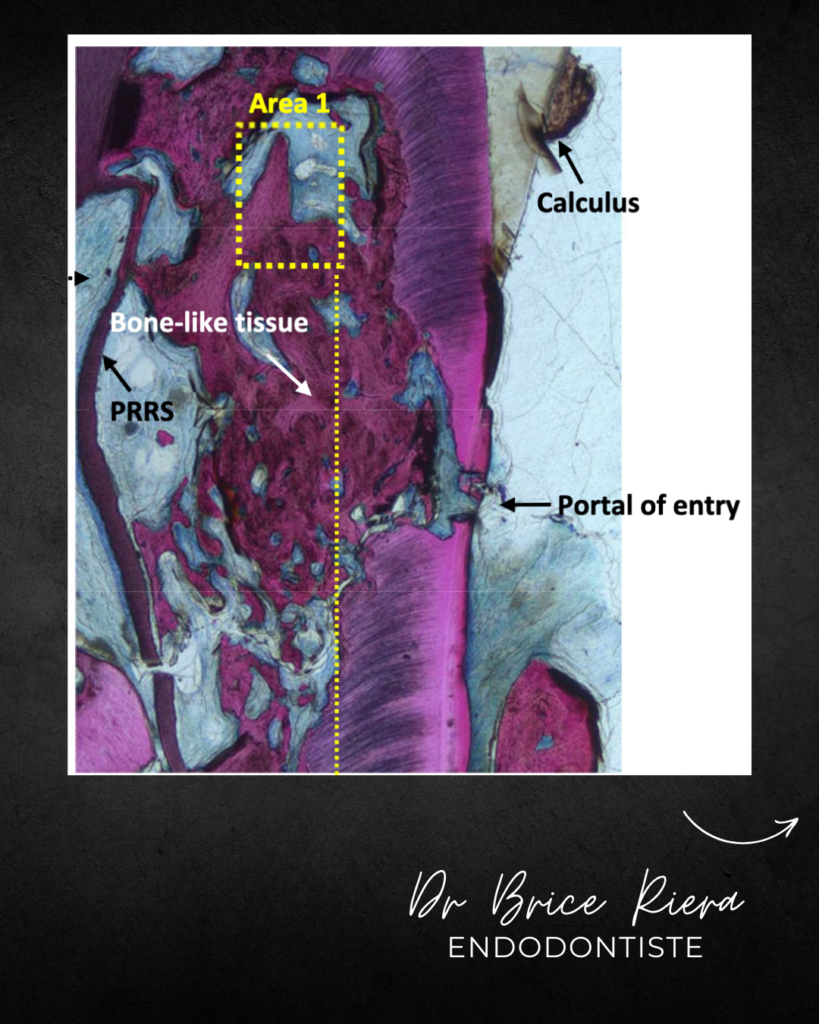 Résorption initiée dans le cément