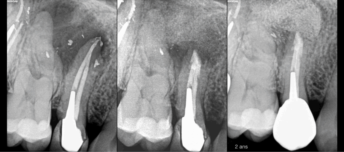 BLOG - DR brice Riera - Endodontiste