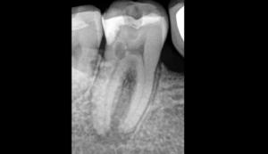 BLOG - Dr Brice Riera - Cas rare resorption radiculaire interne