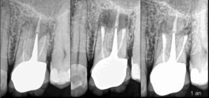 Chirurgie Endodontique & préservation biomécanique