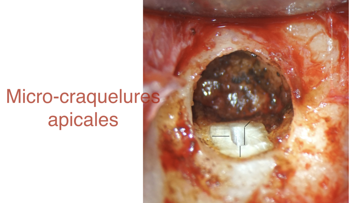 BLOG - Dr Brice Riera - Endodontie et meteo