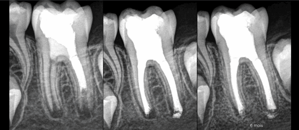 BLOG - Dr Brice Riera - Endodontiste - Cas