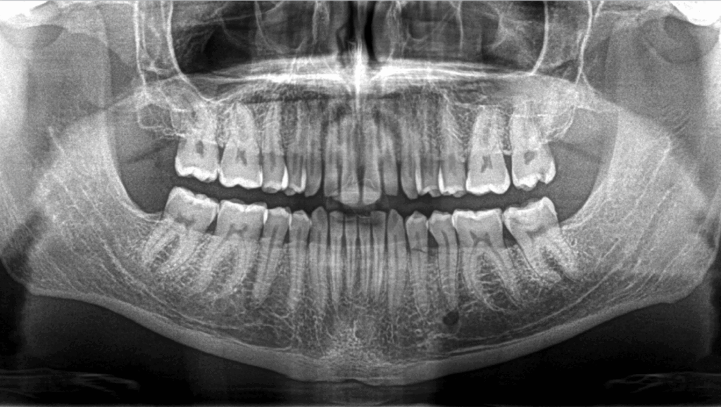 BLOG - Dr Brice Riera - Endodontiste - Cas sensation dents longues