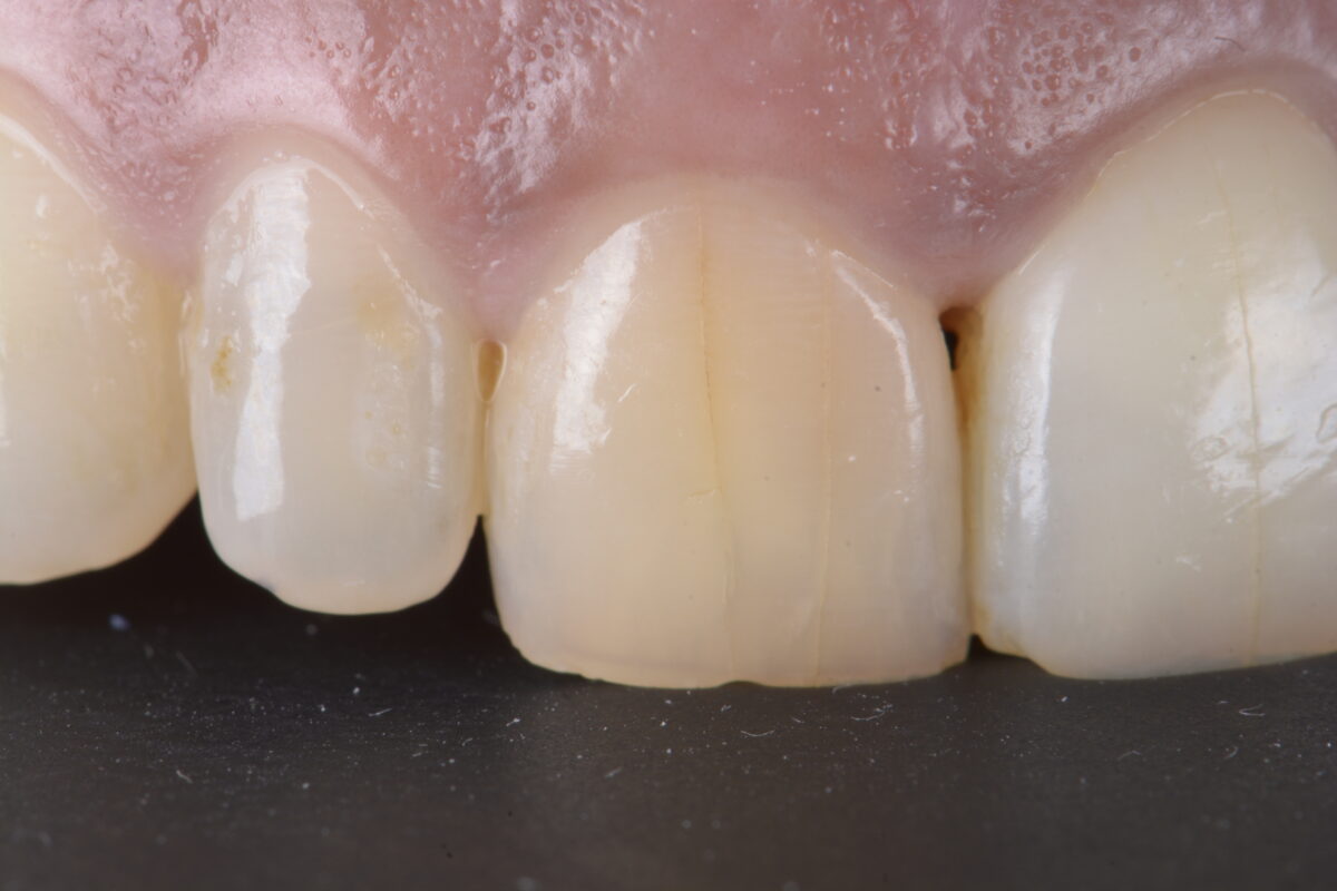 BLOG - Dr Brice Riera - Endodontiste - Craze lines