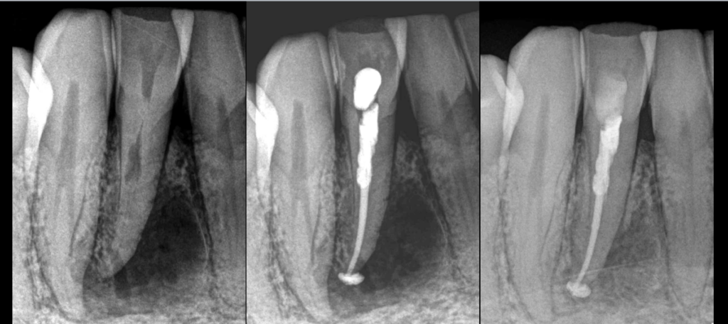 BLOG - Dr Brice Riera - Endodontiste - Particularite dent 43