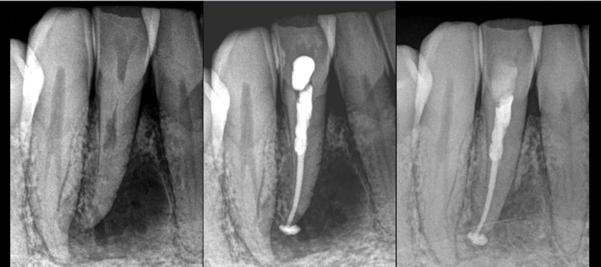 BLOG - Dr Brice Riera - Endodontiste - Particularite dent 43