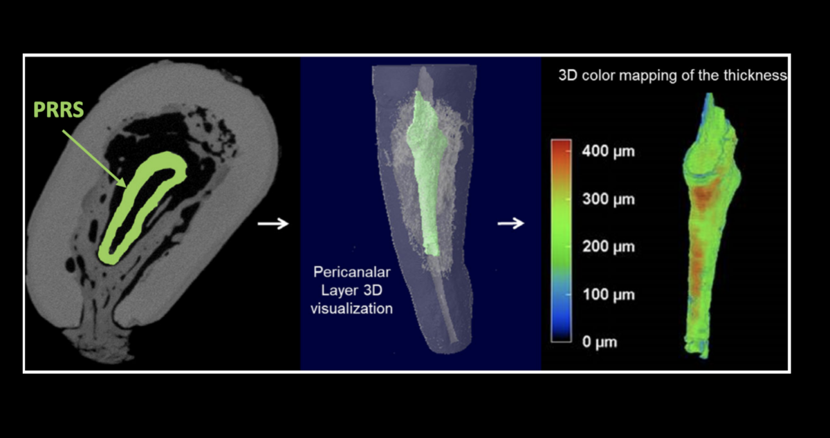 BLOG - Dr Brice Riera - PRRS - Chirurgien Dentiste