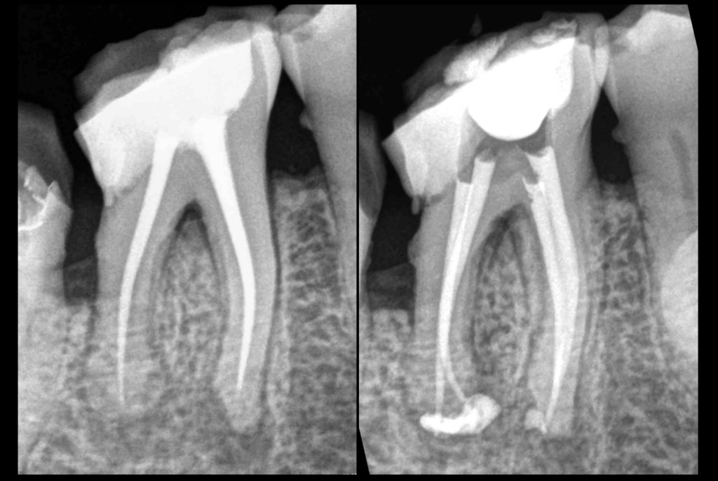 BLOG - Dr Brice Riera - Retraitement canalaire Endodontie