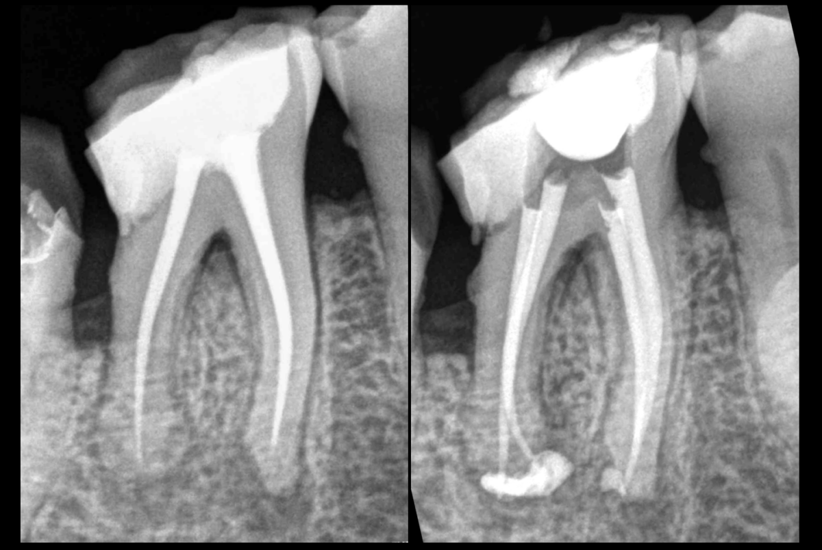 BLOG - Dr Brice Riera - Retraitement canalaire Endodontie