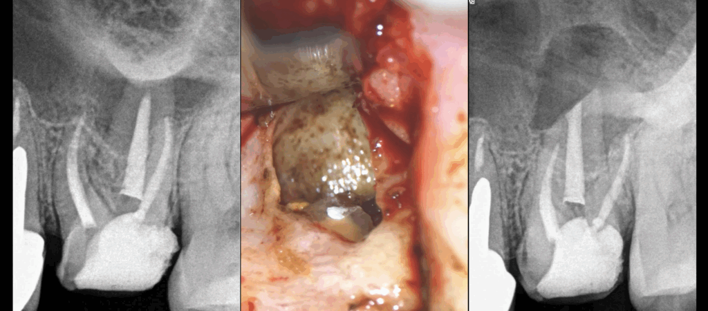 BLOG - Dr Brice Riera - endodontie par Voie Palatine