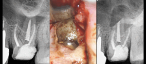 BLOG - Dr Brice Riera - endodontie par Voie Palatine