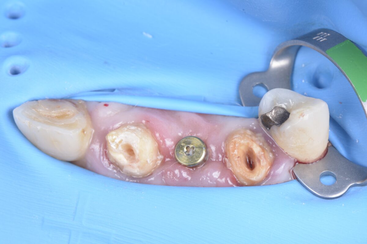 BLOG _ Dr Brice Riera - EDTM.- Chirurgien Dentiste Endodontie - synergie implanto endo