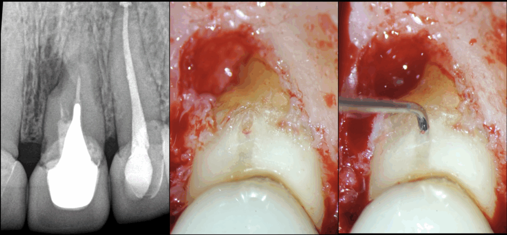 1 - BLOG - Dr Brice Riera - EDTM - Endodontie Paris - cas 21 22