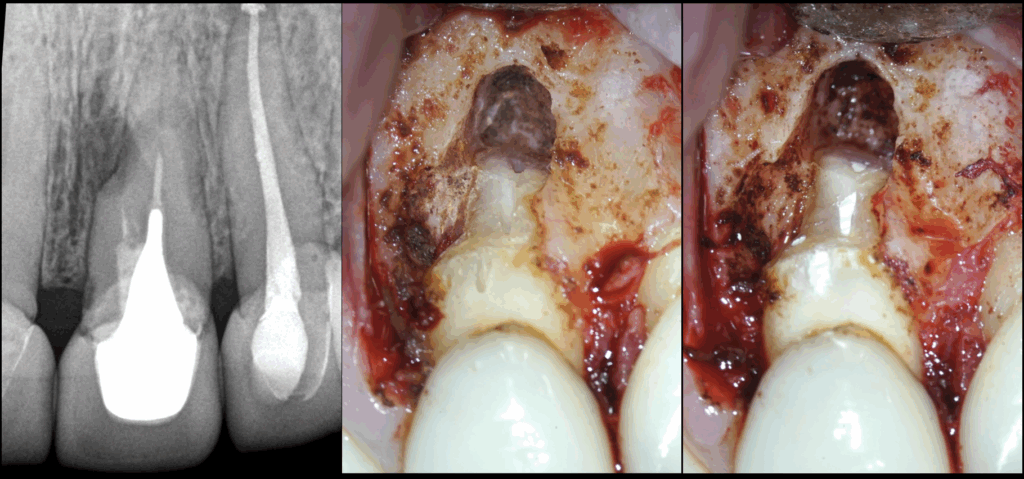 2 - BLOG - Dr Brice Riera - EDTM - Endodontie Paris - cas 21 22