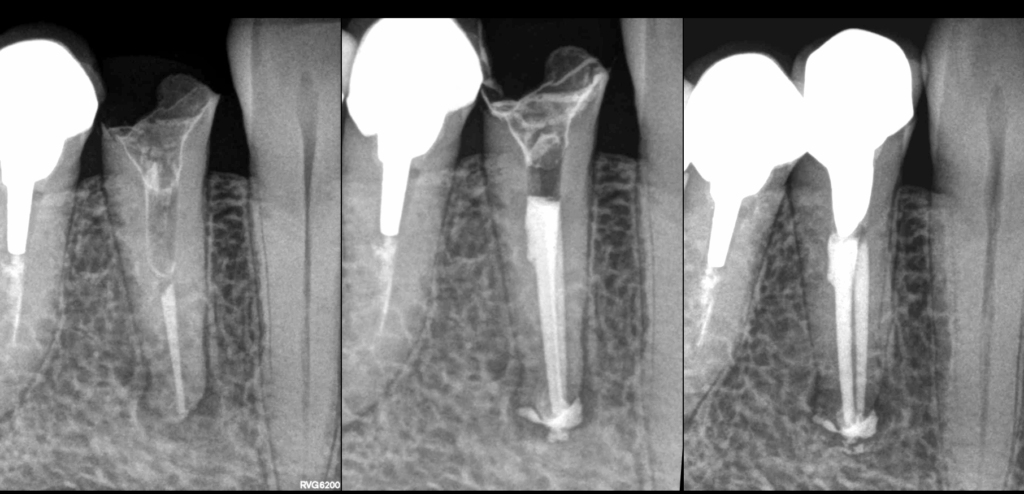 BLOG - Dr BRice Riera - EDTM - Endodontie - Dent 44 adressee car traitement non efficace