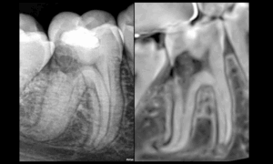 BLOG - Dr Brice RIera - EDTM - Endodontie - quel est le plus gros probleme ici