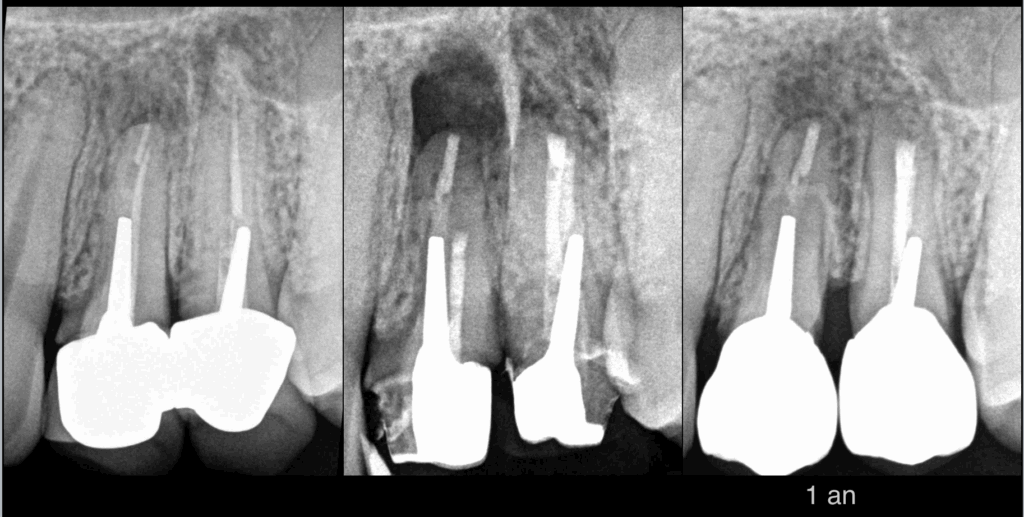 BLOG - Dr Brice Riera - EDTM - Chirurgie Dentaire - Cas chirurgie