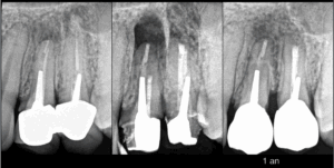 BLOG - Dr Brice Riera - EDTM - Chirurgie Dentaire - Cas chirurgie